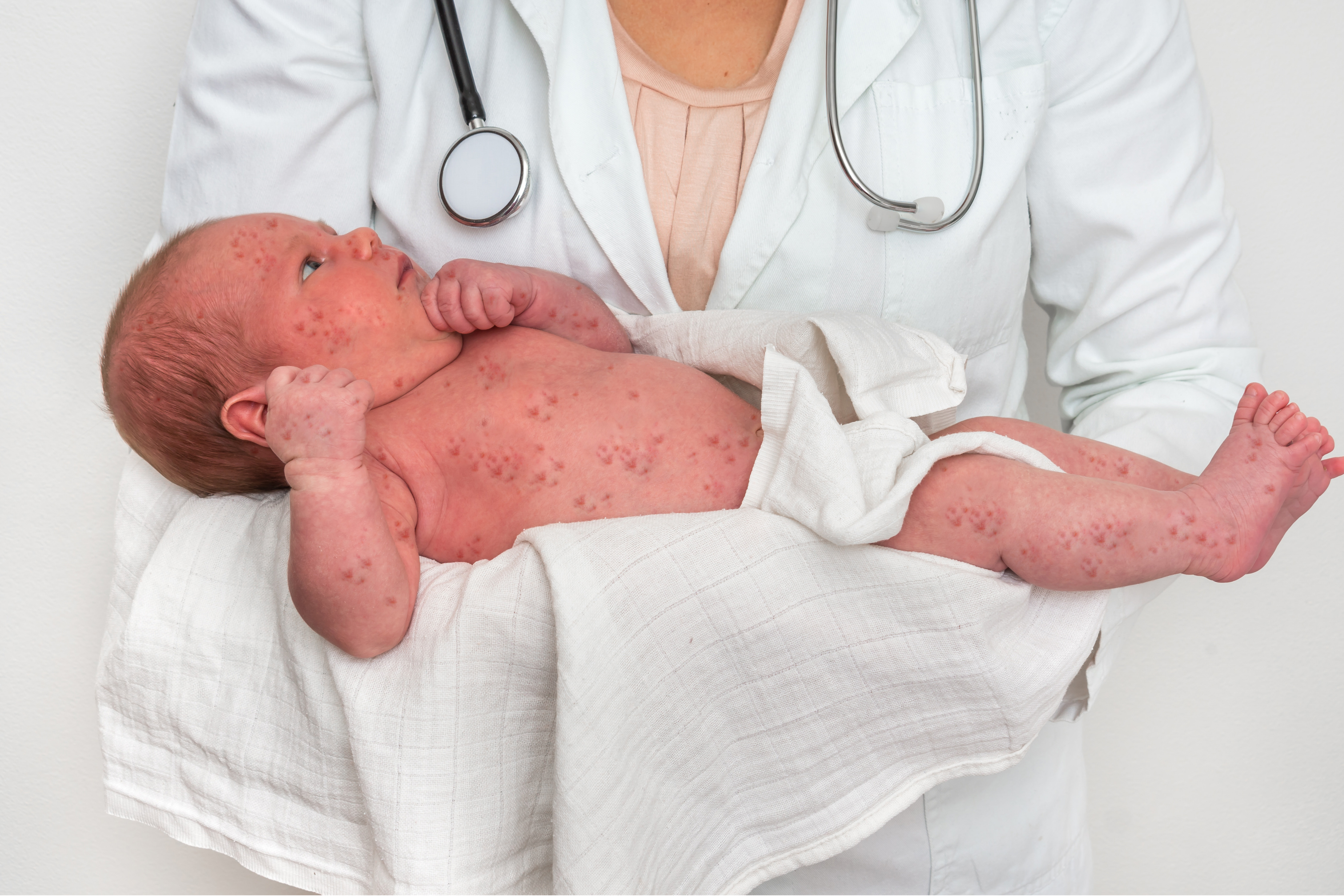 Sarampo cresce 32 vezes nas Américas em um ano; veja situação do Brasil